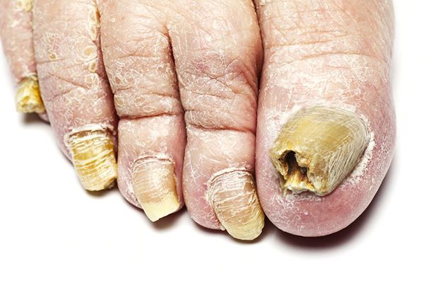 nail fungus cure a körömgomba okai és kezelése