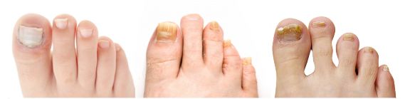 gomba nail foot futó kezelése